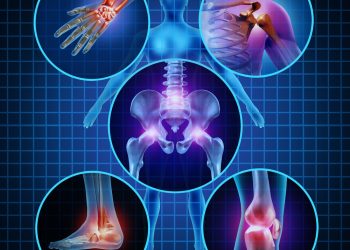 Arthritis
