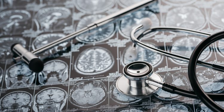 Verständnis der Ursachen von venösen Angriffen der Hirnarterie – Oren Zarif